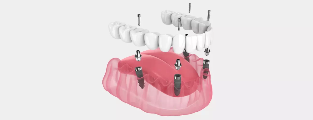 A Complete Guide to Dental Implants: Types and Procedures