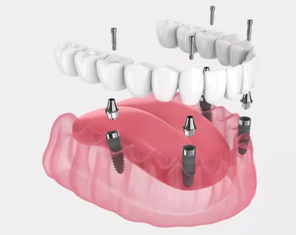 A Complete Guide to Dental Implants: Types and Procedures