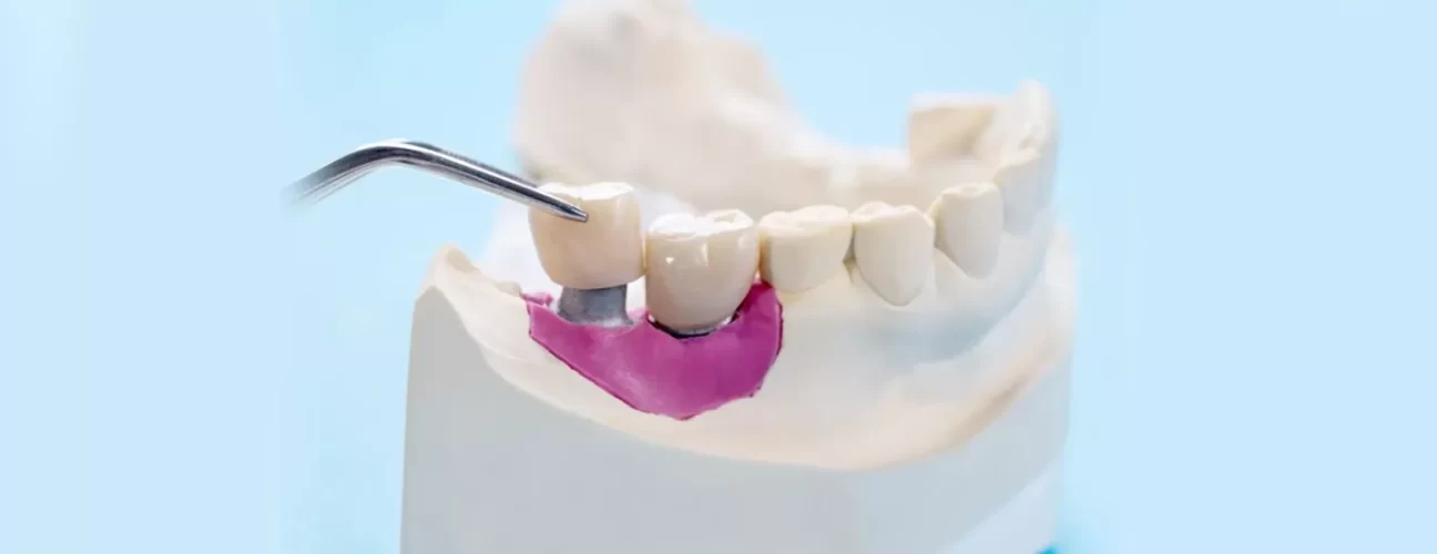 Everything You Need to Know About Types of Dental Crowns