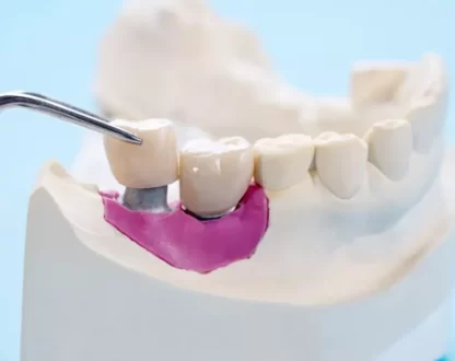 Everything You Need to Know About Types of Dental Crowns