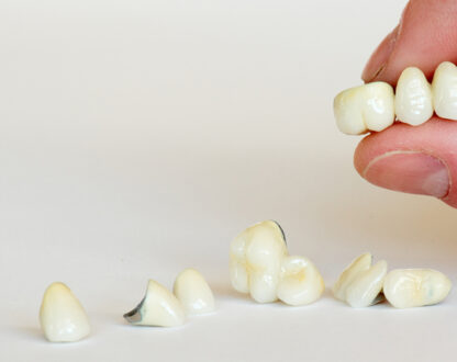 Front Teeth Crowns vs. Veneers