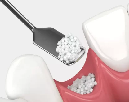 Bone Grafting in Dental Implants: When and Why It’s Needed