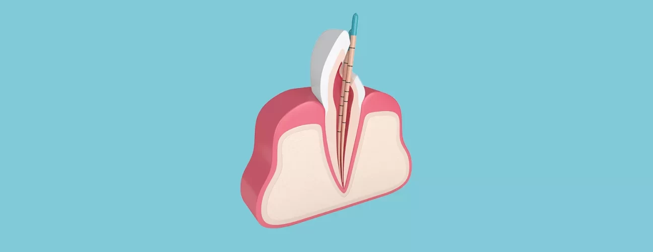 Gutta-Percha: The Standard Material for Root Canal Sealing