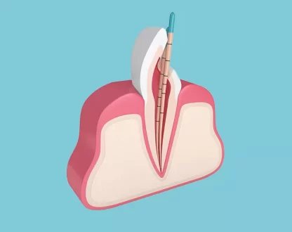 Gutta-Percha: The Standard Material for Root Canal Sealing