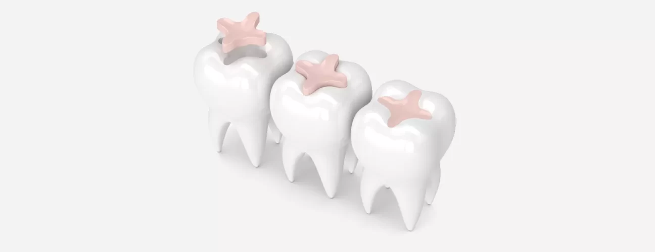 Temporary Fillings After Root Canal: Why They’re Important