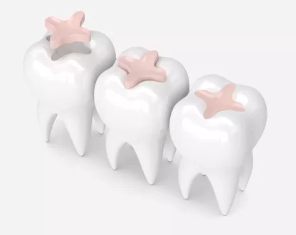 Temporary Fillings After Root Canal: Why They’re Important