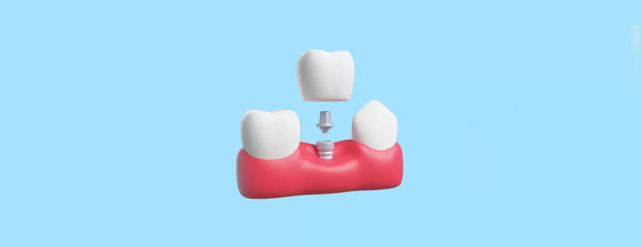 How Long Do Dental Implants Last? Key Facts You Should Know