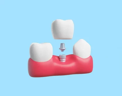 How Long Do Dental Implants Last? Key Facts You Should Know