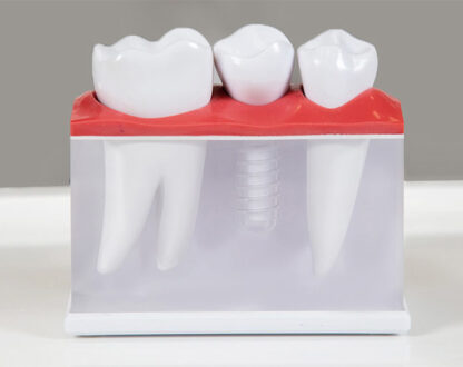 Dental Implants with Bone Loss: What You Need to Know