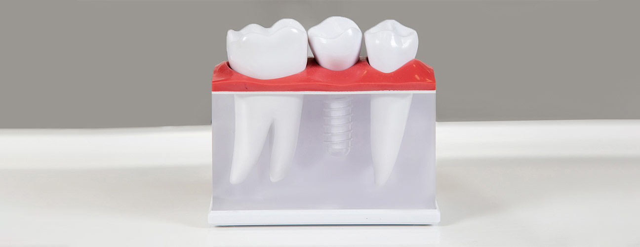 Dental Implants with Bone Loss: What You Need to Know